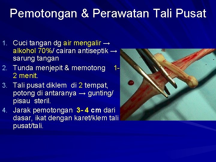 Pemotongan & Perawatan Tali Pusat 1. Cuci tangan dg air mengalir → 2. 3.