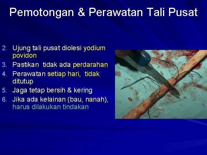 Pemotongan & Perawatan Tali Pusat 2. Ujung tali pusat diolesi yodium 3. 4. 5.