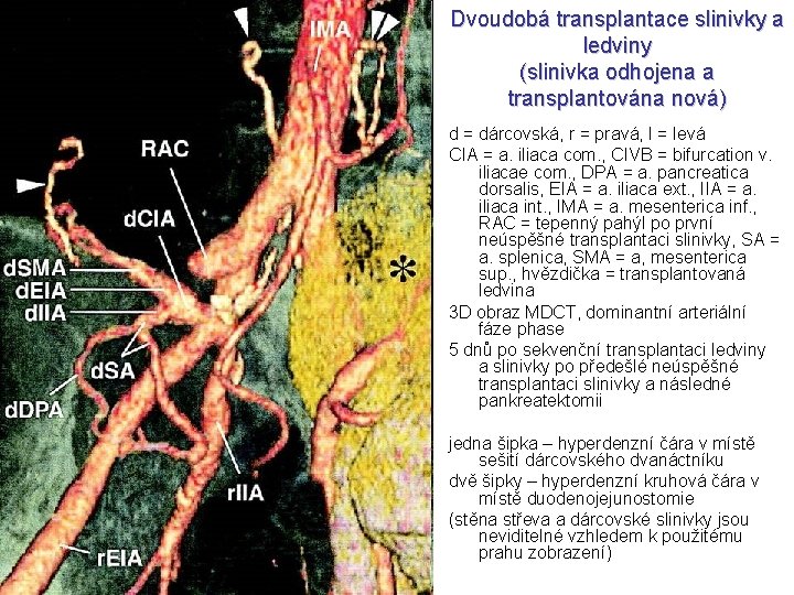 Dvoudobá transplantace slinivky a ledviny (slinivka odhojena a transplantována nová) d = dárcovská, r