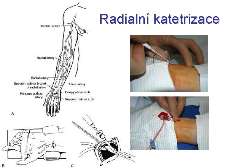 Radialní katetrizace 