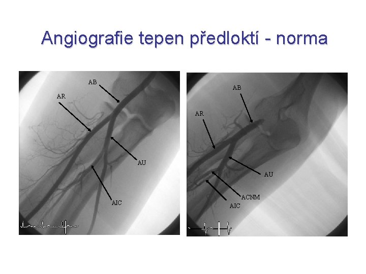 Angiografie tepen předloktí - norma AB AB AR AR AU AU AIC ACNM AIC