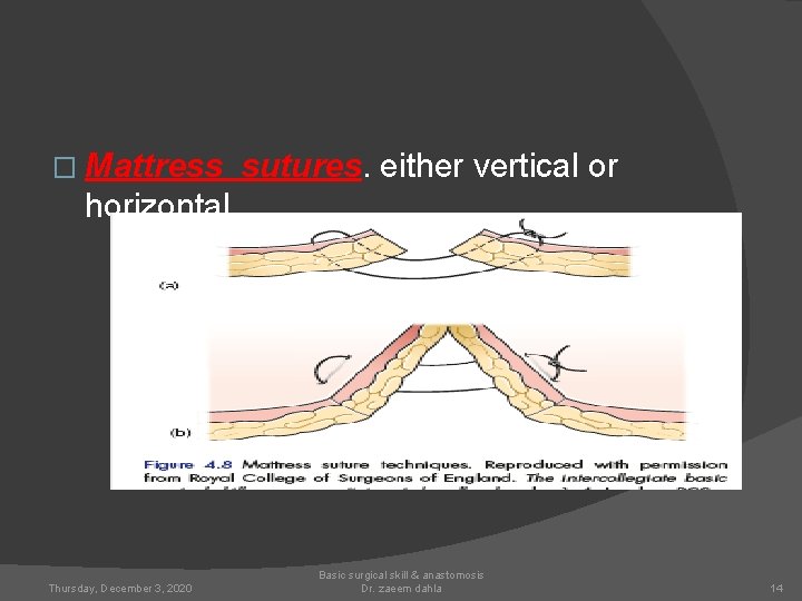 � Mattress sutures. either vertical or horizontal Thursday, December 3, 2020 Basic surgical skill