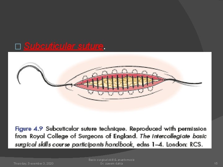 � Subcuticular Thursday, December 3, 2020 suture. Basic surgical skill & anastomosis Dr. zaeem