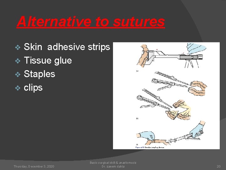 Alternative to sutures Skin adhesive strips. v Tissue glue v Staples v clips v