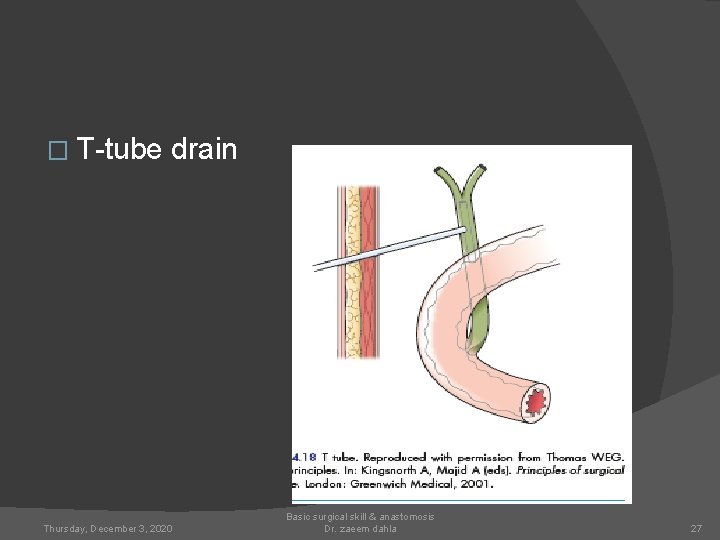� T-tube drain Thursday, December 3, 2020 Basic surgical skill & anastomosis Dr. zaeem