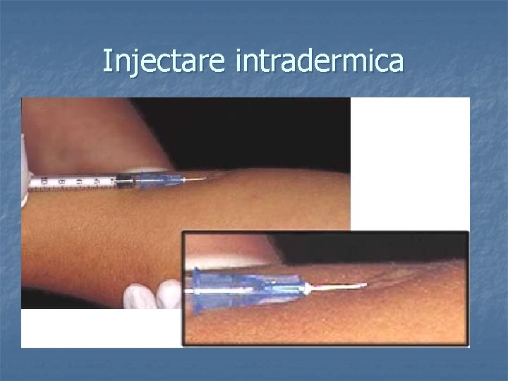 Injectare intradermica 