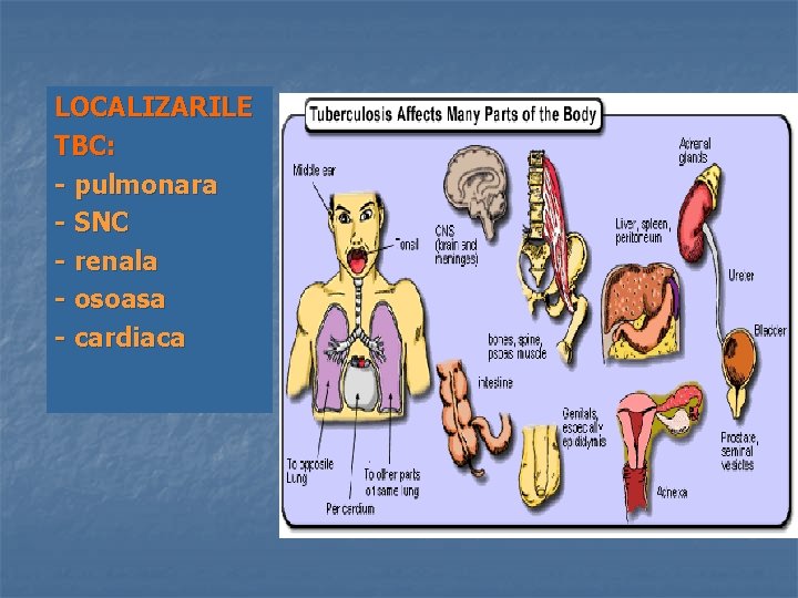 LOCALIZARILE TBC: - pulmonara - SNC - renala - osoasa - cardiaca 