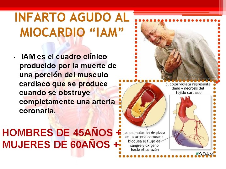 INFARTO AGUDO AL MIOCARDIO “IAM” • IAM es el cuadro clínico producido por la