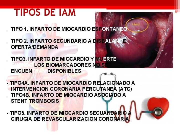 TIPOS DE IAM - - - TIPO 1. INFARTO DE MIOCARDIO ESPONTANEO TIPO 2.