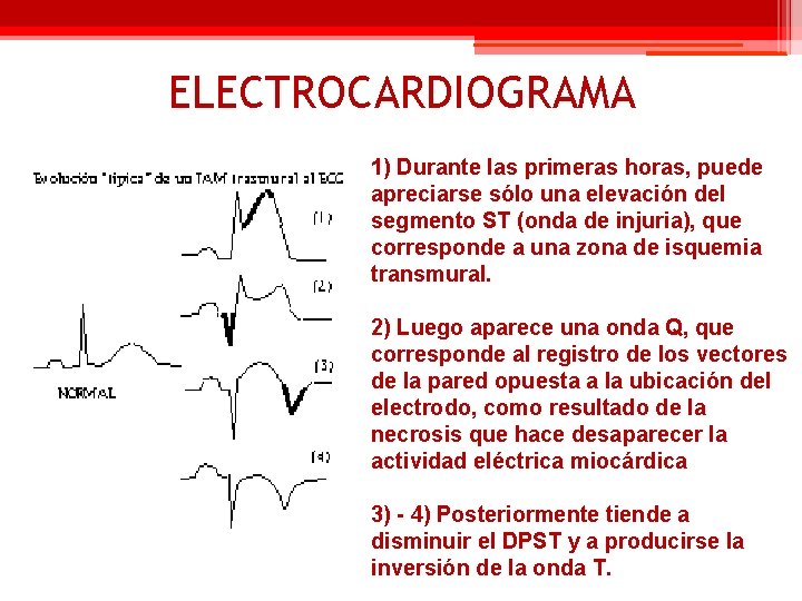 ELECTROCARDIOGRAMA 1) Durante las primeras horas, puede apreciarse sólo una elevación del segmento ST