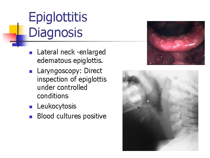 Epiglottitis Diagnosis n n Lateral neck -enlarged edematous epiglottis. Laryngoscopy: Direct inspection of epiglottis