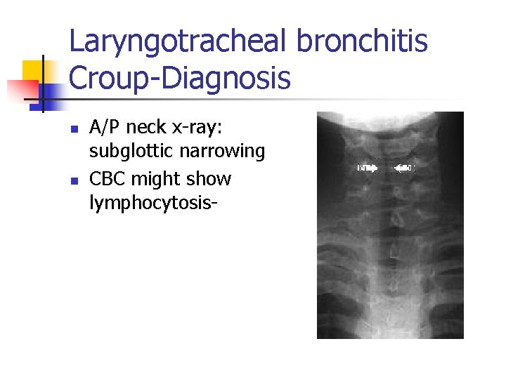 Laryngotracheal bronchitis Croup-Diagnosis n n A/P neck x-ray: subglottic narrowing CBC might show lymphocytosis-