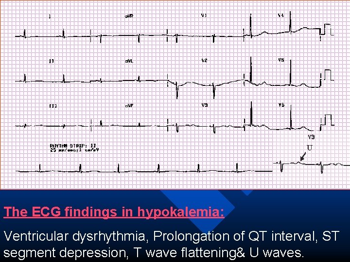 The ECG findings in hypokalemia: Ventricular dysrhythmia, Prolongation of QT interval, ST segment depression,