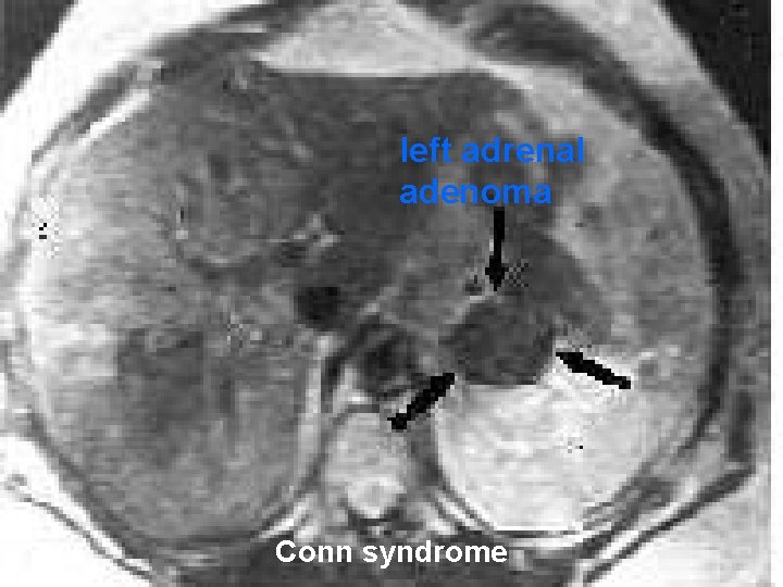 n left adrenal adenoma Conn syndrome 