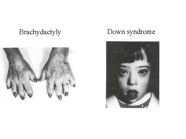 Brachydactyly Down syndrome  Brachydactyly Down syndrome
