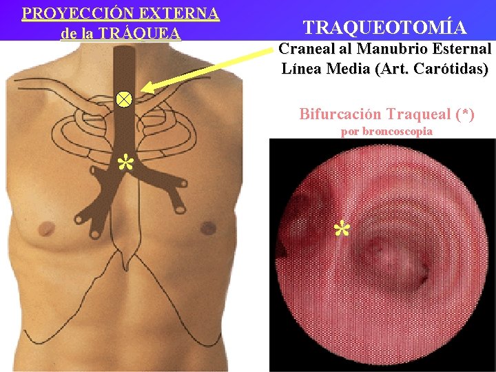 PROYECCIÓN EXTERNA de la TRÁQUEA TRAQUEOTOMÍA Craneal al Manubrio Esternal Línea Media (Art. Carótidas)