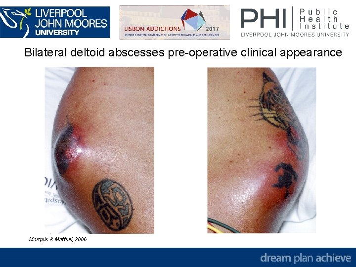 Bilateral deltoid abscesses pre-operative clinical appearance Marquis & Maffulli, 2006 