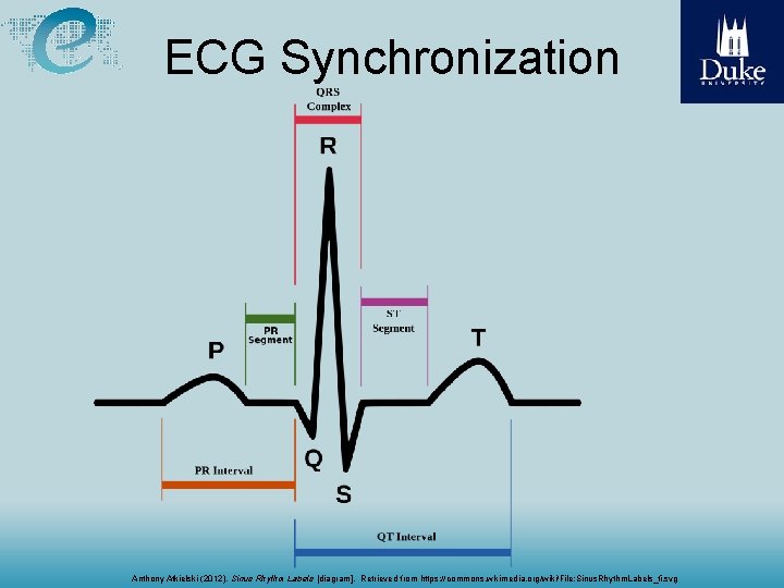 ECG Synchronization Anthony Atkielski (2012), Sinus Rhythm Labels [diagram]. Retrieved from https: //commons. wikimedia.