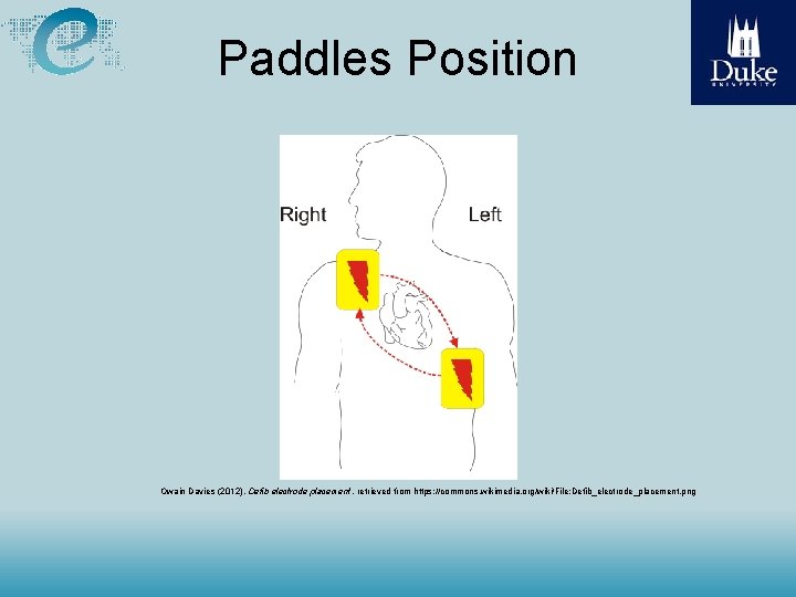  Paddles Position Owain Davies (2012), Defib electrode placement, retrieved from https: //commons. wikimedia.