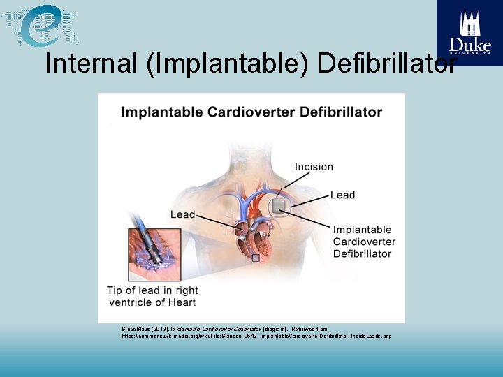 Internal (Implantable) Defibrillator Bruce. Blaus (2013), Implantable Cardioverter Defibrilator [diagram]. Retrieved from https: //commons.
