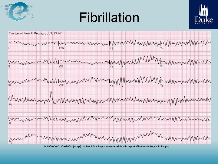 Fibrillation Jer 5150 (2012) Fibrillation [Image], retrieved from https: //commons. wikimedia. org/wiki/File: Ventricular_fibrillation. png
