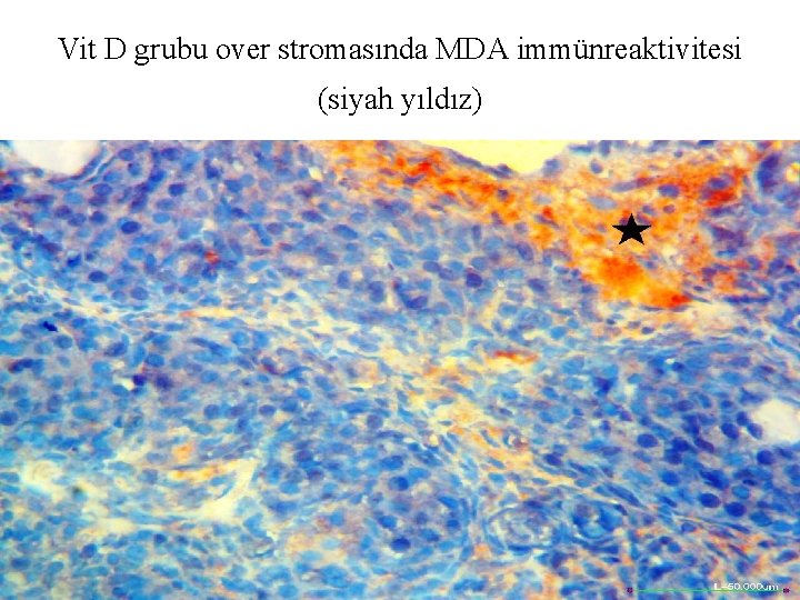 Vit D grubu over stromasında MDA immünreaktivitesi (siyah yıldız) 