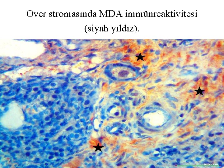 Over stromasında MDA immünreaktivitesi (siyah yıldız). 