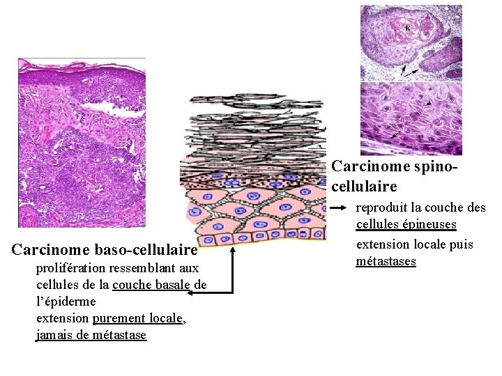 Carcinome spinocellulaire Carcinome baso-cellulaire prolifération ressemblant aux cellules de la couche basale de l’épiderme