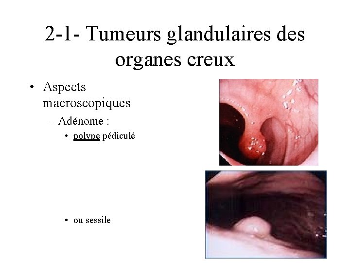 2 -1 - Tumeurs glandulaires des organes creux • Aspects macroscopiques – Adénome :