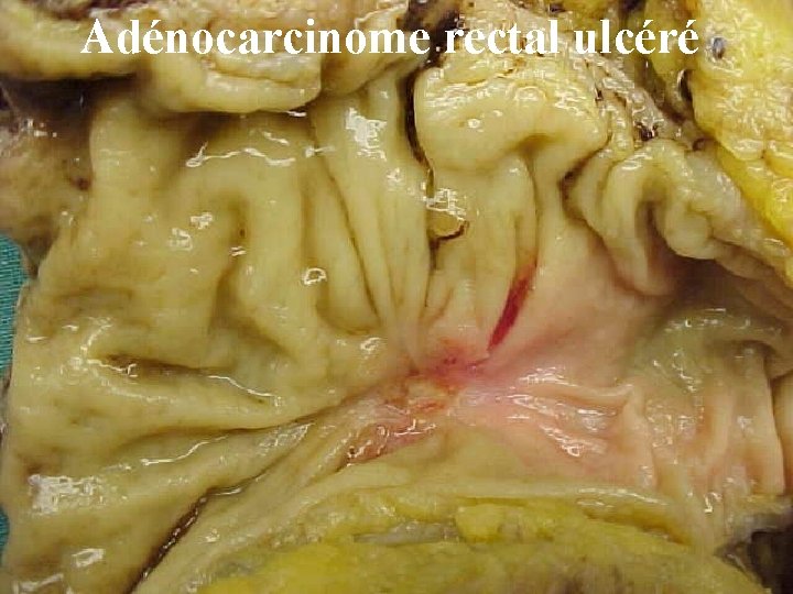 Adénocarcinome rectal ulcéré 