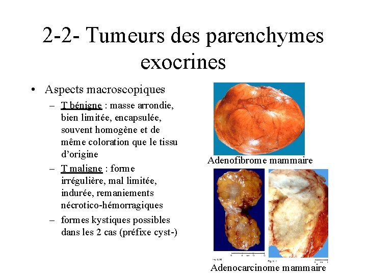 2 -2 - Tumeurs des parenchymes exocrines • Aspects macroscopiques – T bénigne :