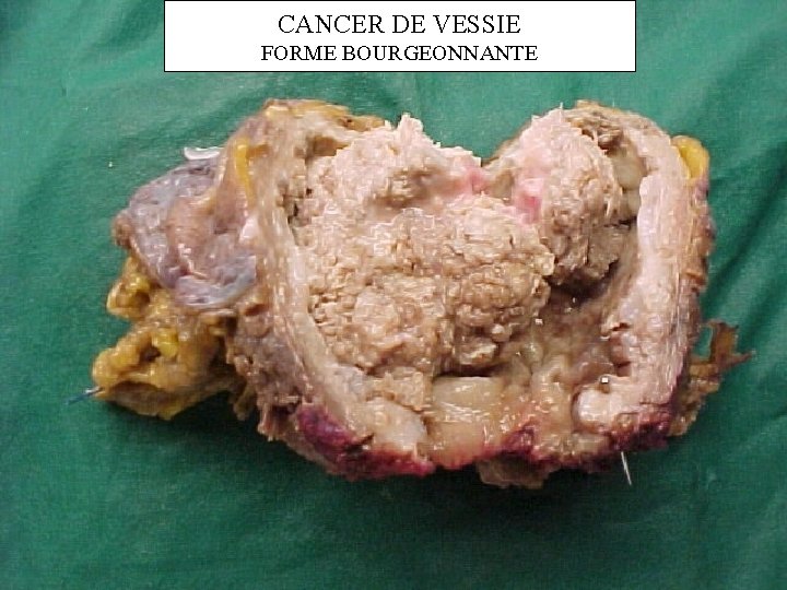 CANCER DE VESSIE FORME BOURGEONNANTE 