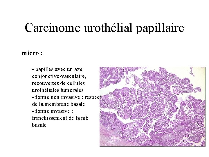 Carcinome urothélial papillaire micro : - papilles avec un axe conjonctivo-vasculaire, recouvertes de cellules