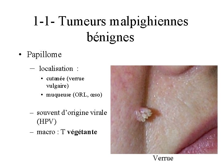 1 -1 - Tumeurs malpighiennes bénignes • Papillome – localisation : • cutanée (verrue