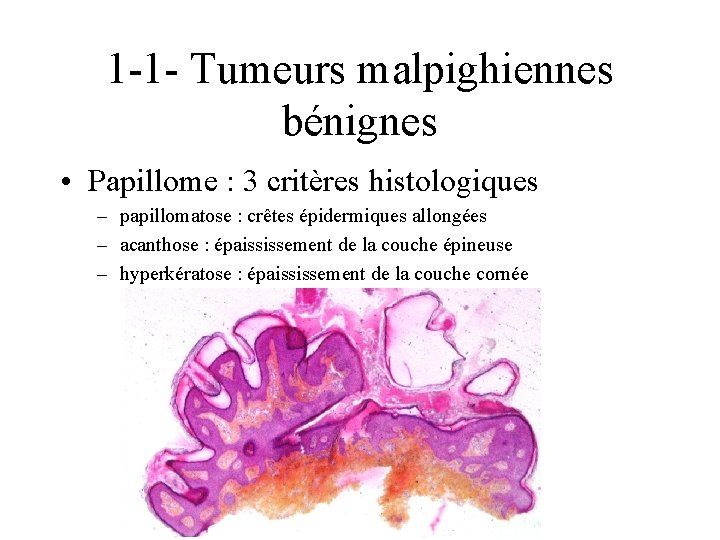 1 -1 - Tumeurs malpighiennes bénignes • Papillome : 3 critères histologiques – papillomatose