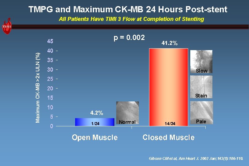 TMPG and Maximum CK-MB 24 Hours Post-stent All Patients Have TIMI 3 Flow at