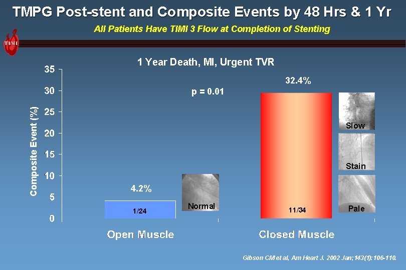 TMPG Post-stent and Composite Events by 48 Hrs & 1 Yr All Patients Have