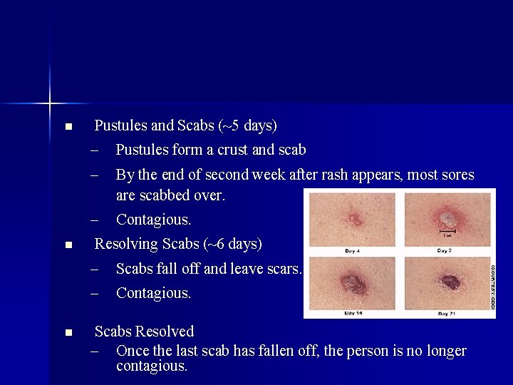 n Pustules and Scabs (~5 days) – – n By the end of second