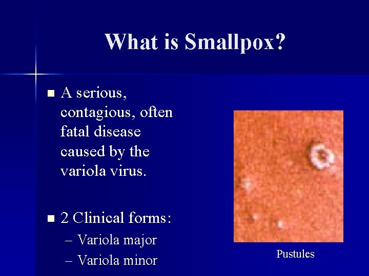 What is Smallpox? n A serious, contagious, often fatal disease caused by the variola