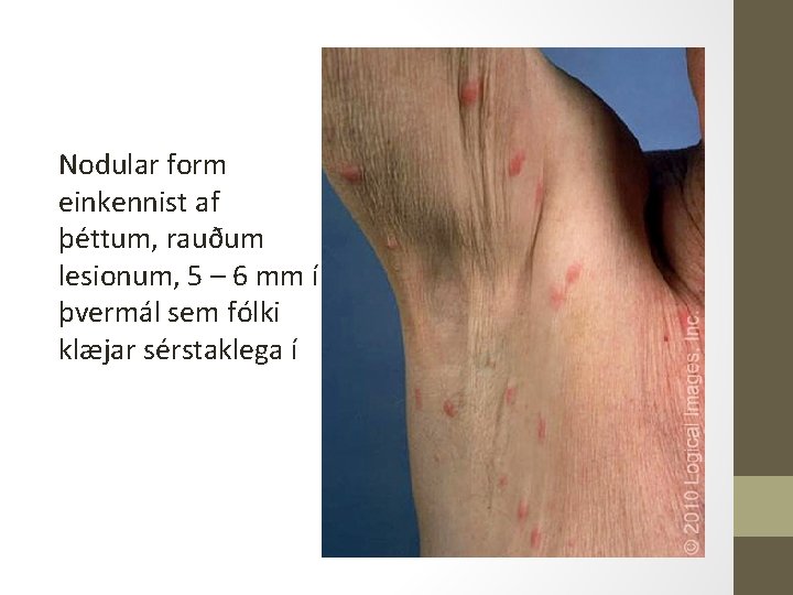 Nodular form einkennist af þéttum, rauðum lesionum, 5 – 6 mm í þvermál sem