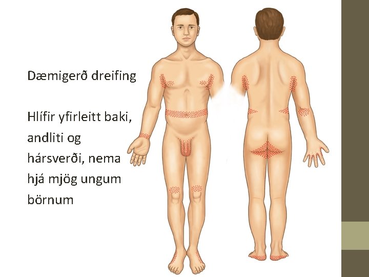 Dæmigerð dreifing Hlífir yfirleitt baki, andliti og hársverði, nema hjá mjög ungum börnum 