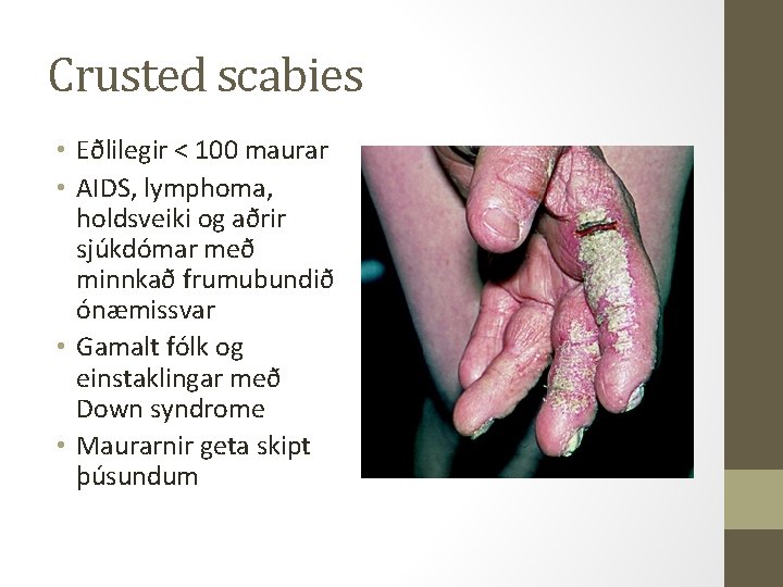 Crusted scabies • Eðlilegir < 100 maurar • AIDS, lymphoma, holdsveiki og aðrir sjúkdómar