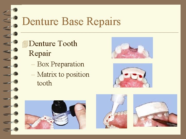 Denture Base Repairs 4 Denture Tooth Repair – Box Preparation – Matrix to position