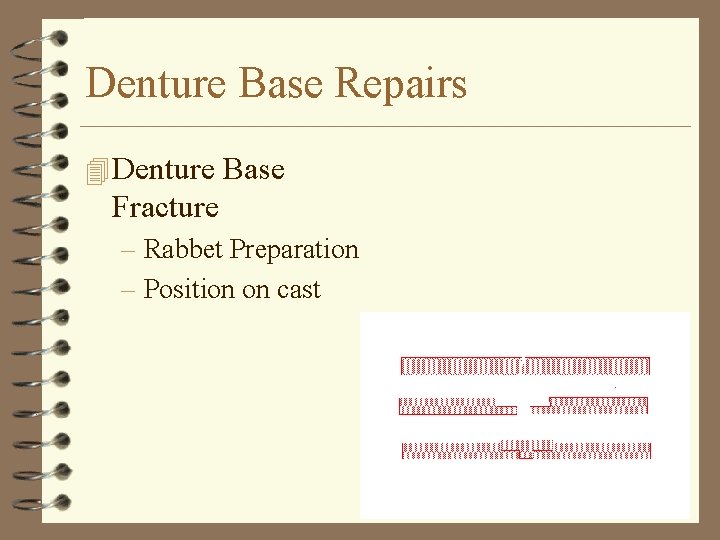 Denture Base Repairs 4 Denture Base Fracture – Rabbet Preparation – Position on cast