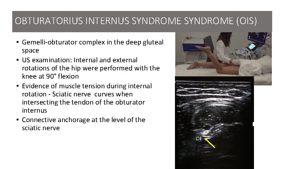 OBTURATORIUS INTERNUS SYNDROME (OIS) • Gemelli-obturator complex in the deep gluteal space • US