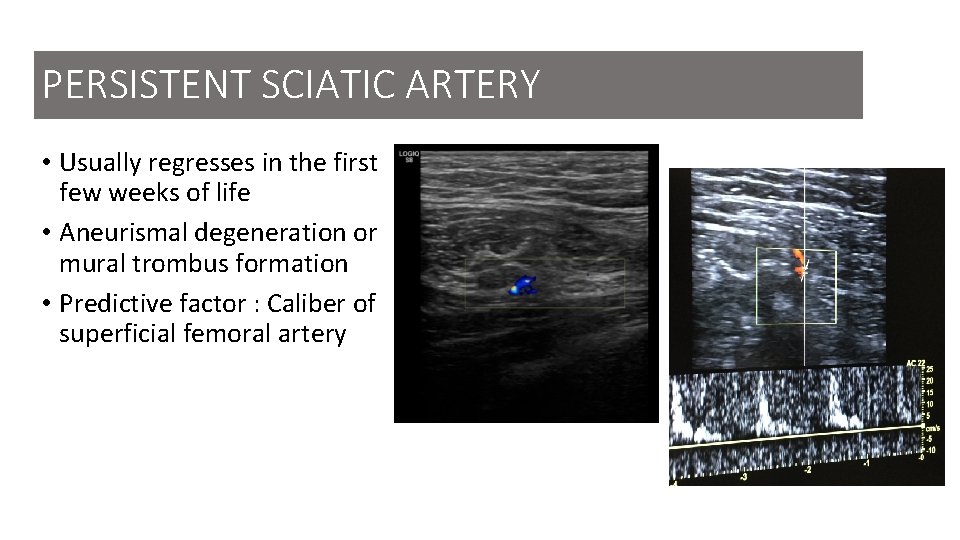 PERSISTENT SCIATIC ARTERY • Usually regresses in the first few weeks of life •