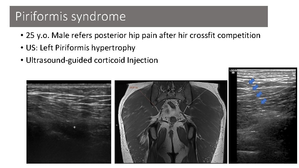 Piriformis syndrome • 25 y. o. Male refers posterior hip pain after hir crossfit