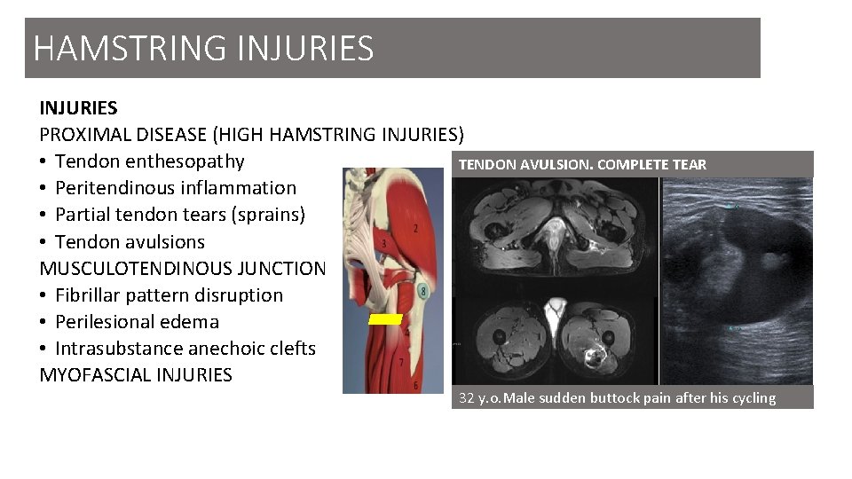 HAMSTRING INJURIES PROXIMAL DISEASE (HIGH HAMSTRING INJURIES) • Tendon enthesopathy TENDON AVULSION. COMPLETE TEAR