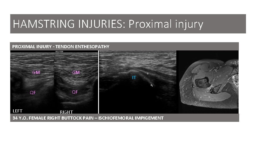 HAMSTRING INJURIES: Proximal injury PROXIMAL INJURY - TENDON ENTHESOPATHY GM QF GM IT QF