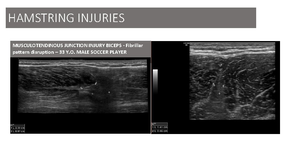 HAMSTRING INJURIES MUSCULOTENDINOUS JUNCTION INJURY BICEPS - Fibrillar pattern disruption – 33 Y. O.